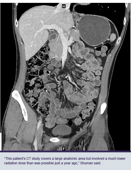 CT body scann