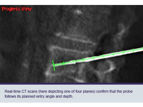 Real-time CT scans (here depicting one of four planes) confirm that the probe follows its planned entry angle and depth.
