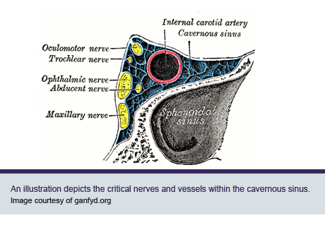 An illustration depicts the critical nerves and vessels within the cavernous sinus.